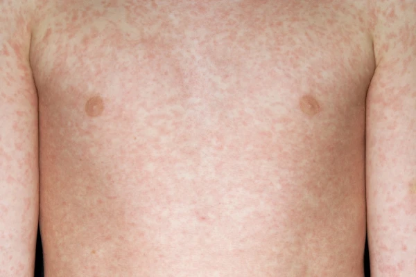 Image for article titled Measles - what do you need to know?